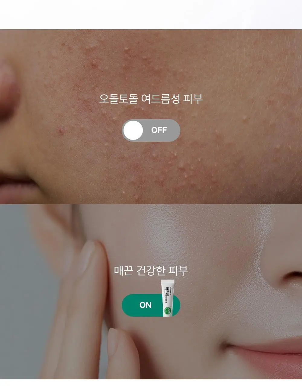 [여드름기능성] 동아제약 아크네 프로 겔제 30ml 상세페이지 7